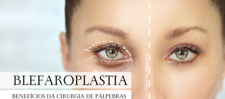 5 Benefícios da cirurgia de pálpebras